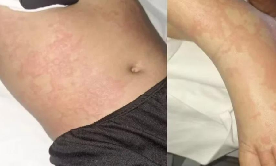 Criança é internada após uso de suposto detergente contaminado no RN